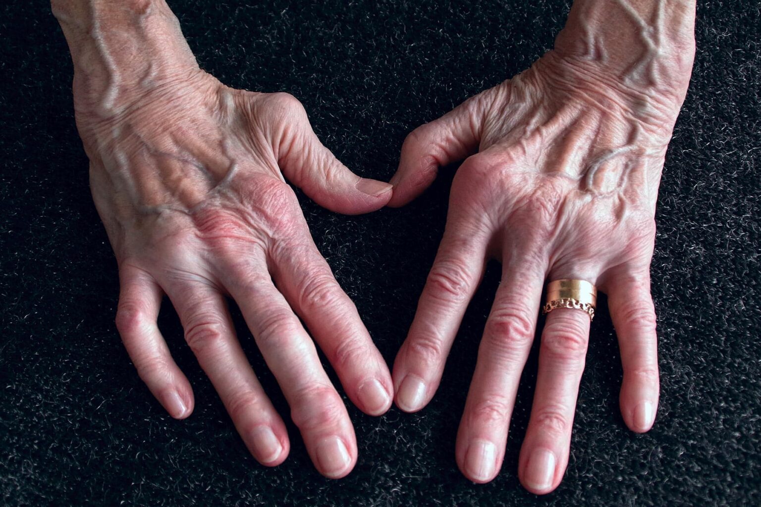 Rheumatoid Arthritis Awareness Week - What You Need to Know - Acubody